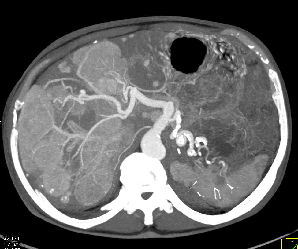 Neuroendocrine Tumor of the Pancreas with Liver Metastases and Collaterals - CTisus CT Scan