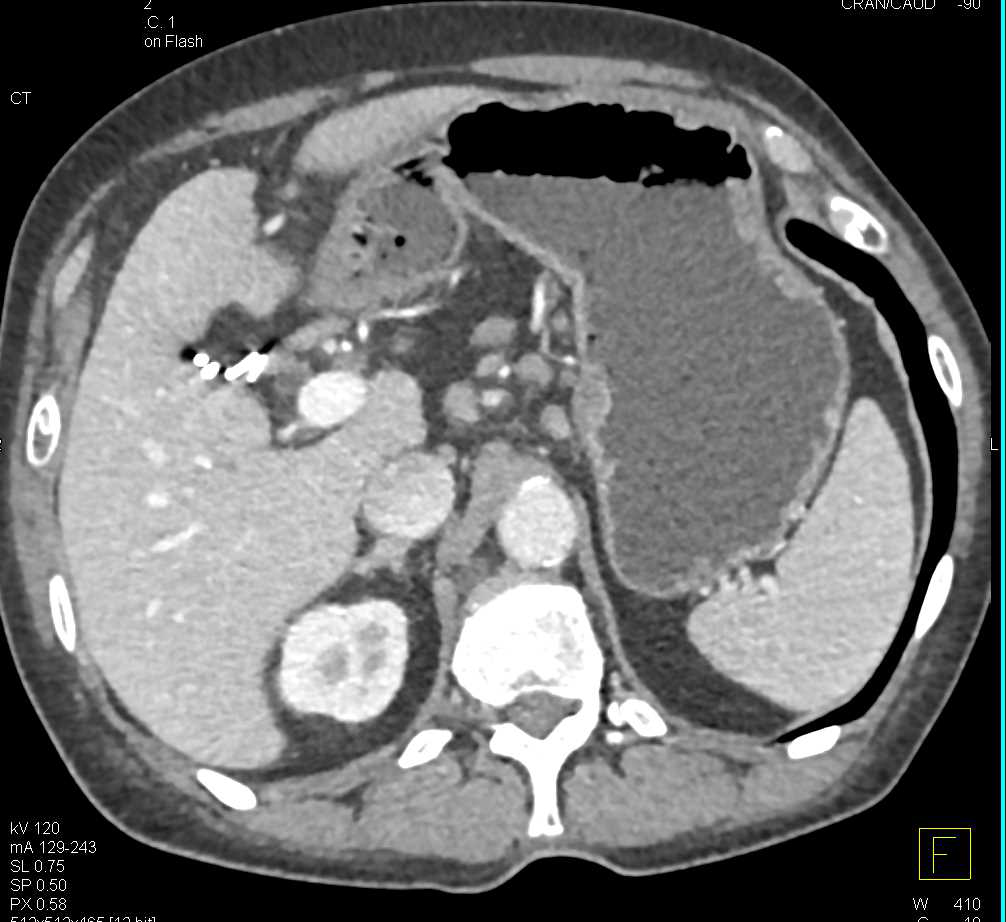 Chronic Pancreatitis with Pseudocyst - CTisus CT Scan