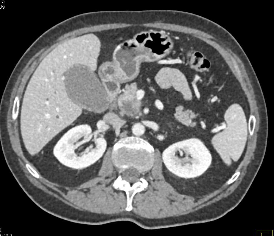 Ampullary Carcinoma - CTisus CT Scan