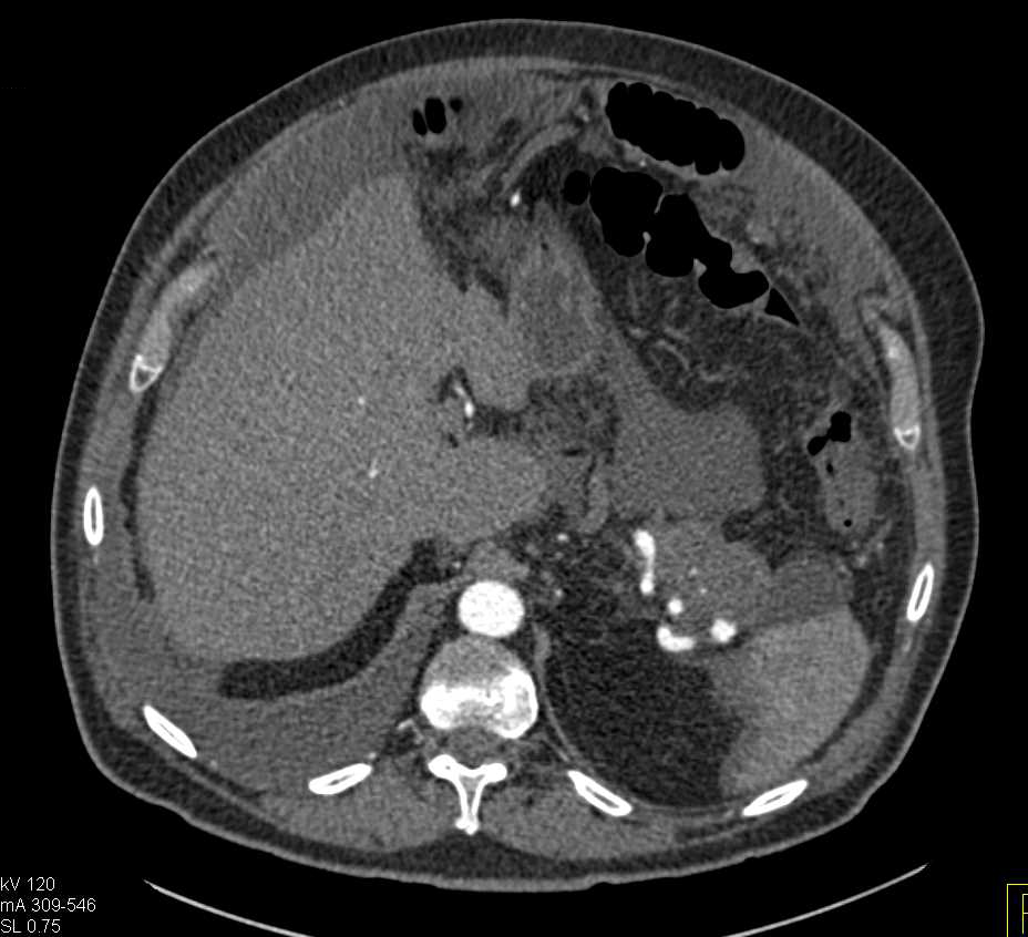 Carcinoma of the Tail of the Pancreas Involves the Spleen and Carcinomatosis - CTisus CT Scan