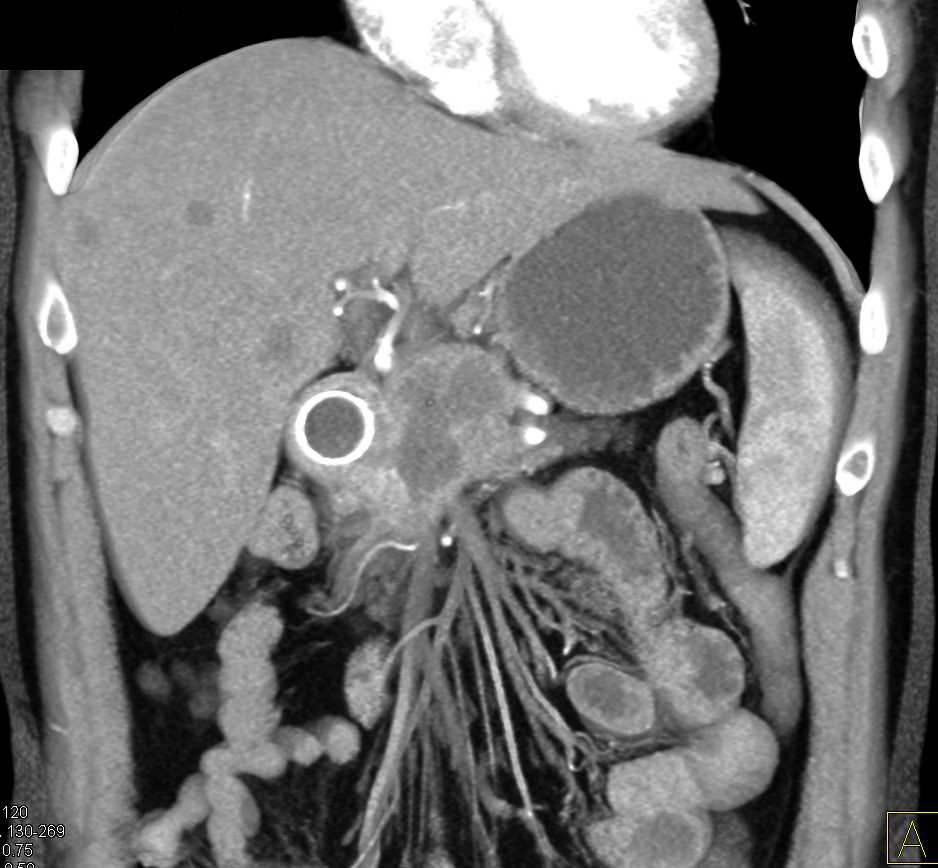Pancreatic Cancer Invades the Duodenum and  Liver Metastases Also Seen - CTisus CT Scan