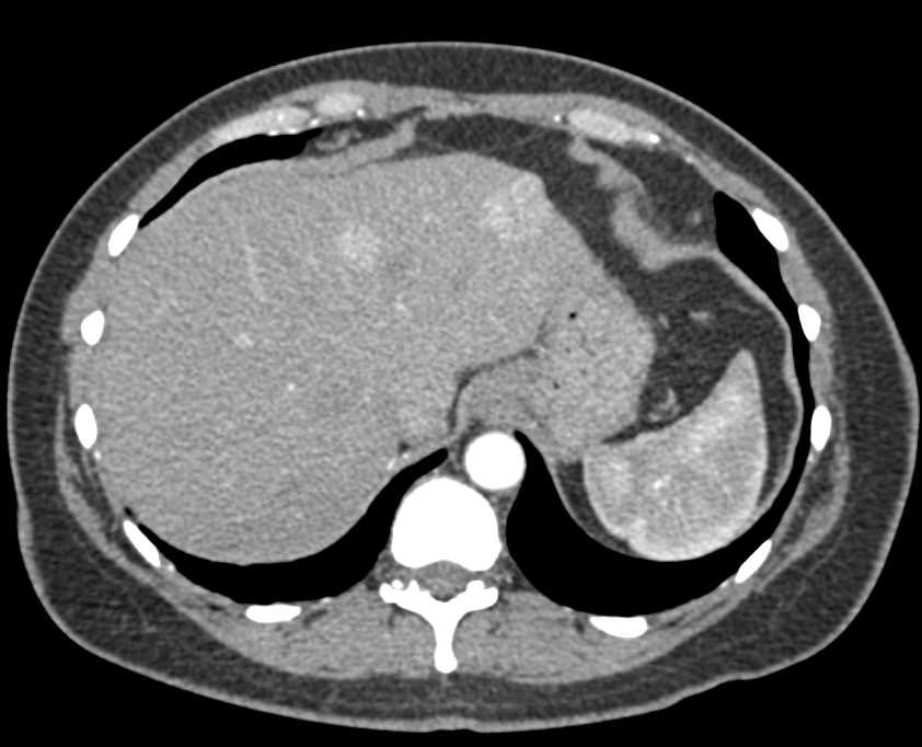 Metastatic Renal Cell Carcinoma to Pancreas and Liver - CTisus CT Scan