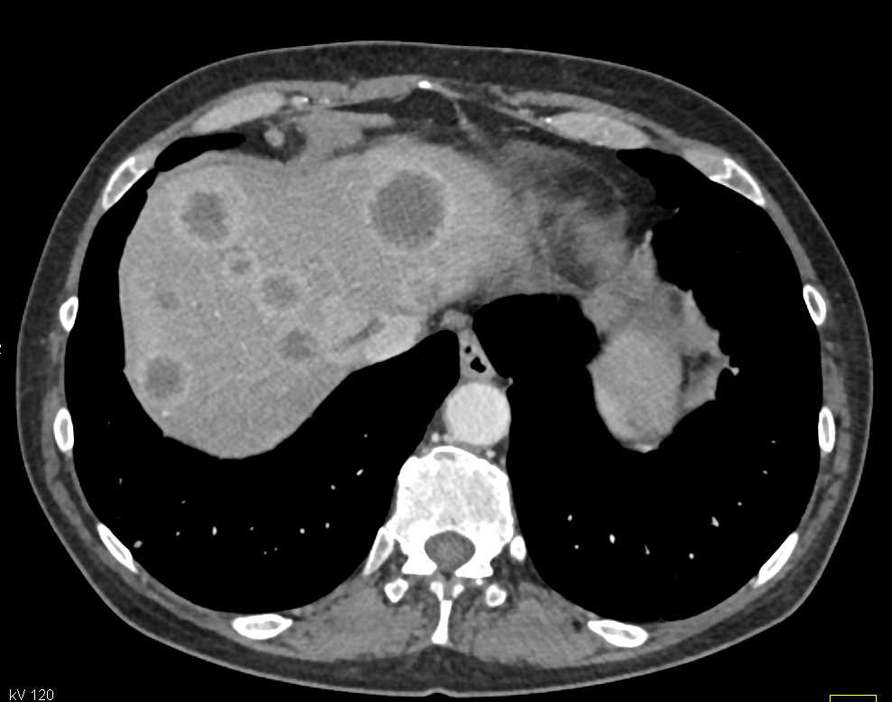Infiltrating Pancreatic Cancer with Liver Metastases - CTisus CT Scan