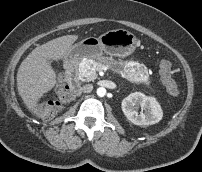 Metastatic Renal Cell Carcinoma to the Pancreas - CTisus CT Scan
