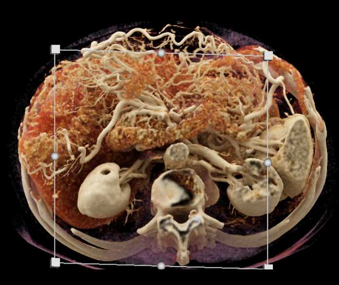 Adenocarcinoma Body of Pancreas with Cinematic Rendering with Vessel Encasement - CTisus CT Scan
