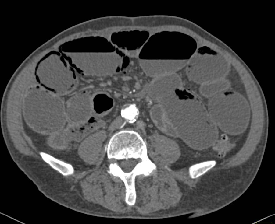 Pneumatosis with Ischemic Bowel - CTisus CT Scan