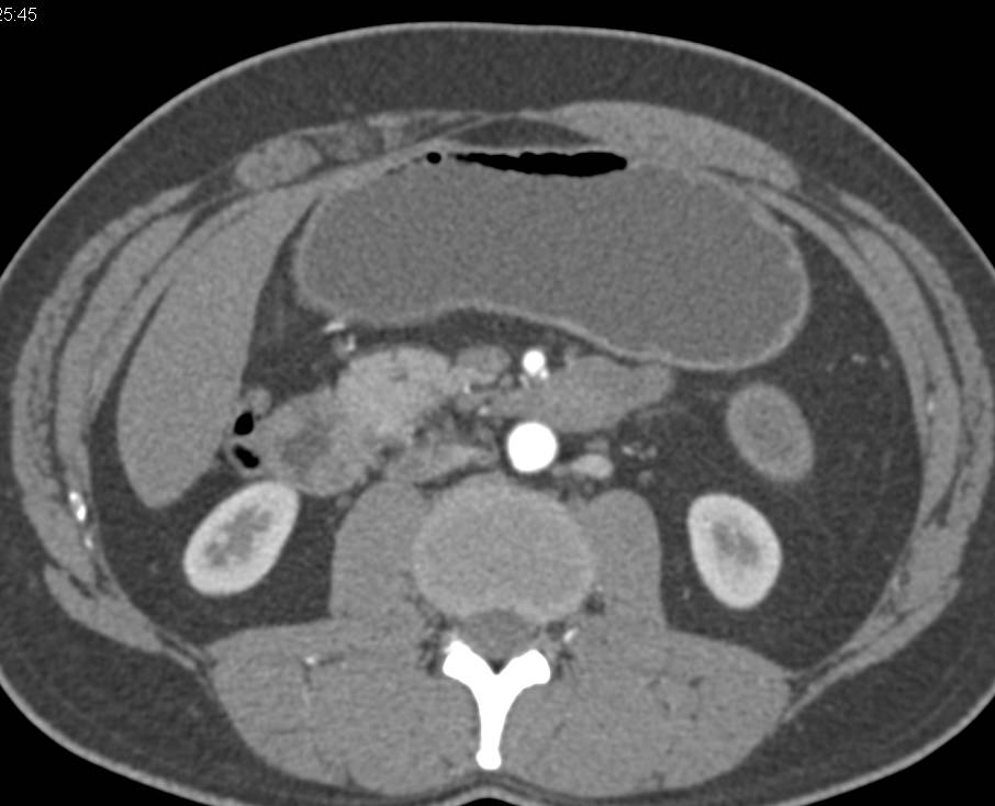 Polyposis Syndrome with Multiple Duodenal Polyps - CTisus CT Scan