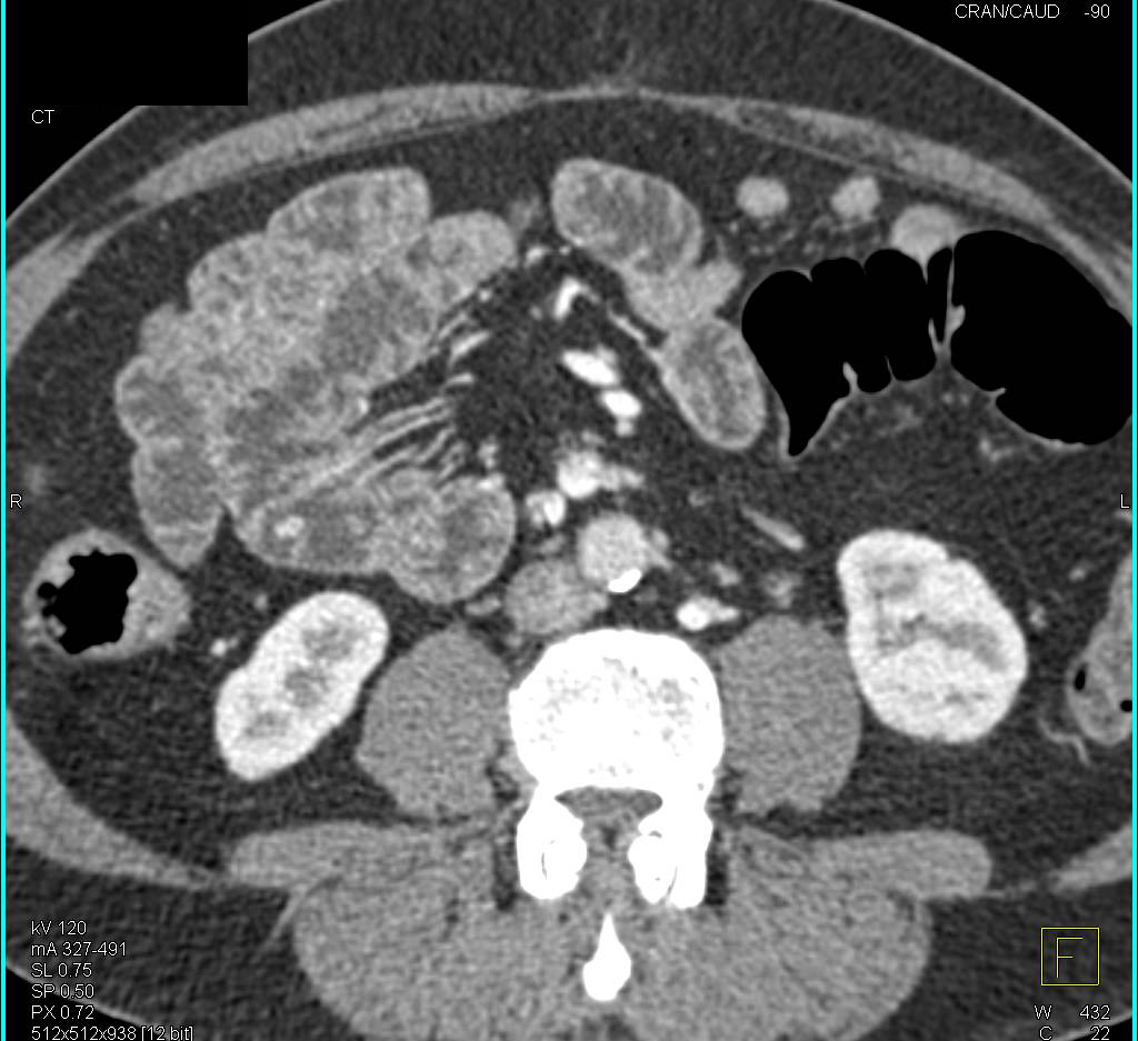Bleeding Site Seen in Mid-Small Bowel with CTA - CTisus CT Scan