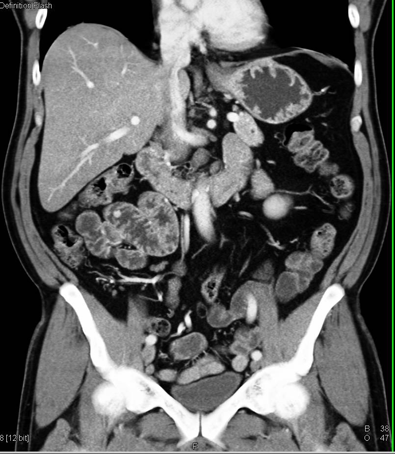 Small Vascular Lesion in Ileum - CTisus CT Scan