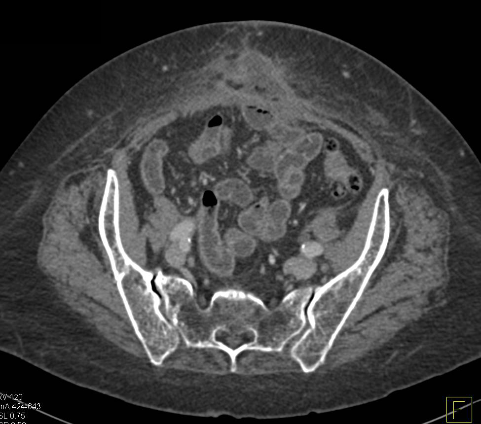Abdominal Wall Abscess and Enterocutaneous Fistulae (ECF) - CTisus CT Scan