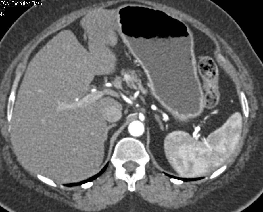 Cystic Small Bowel Carcinoma - CTisus CT Scan