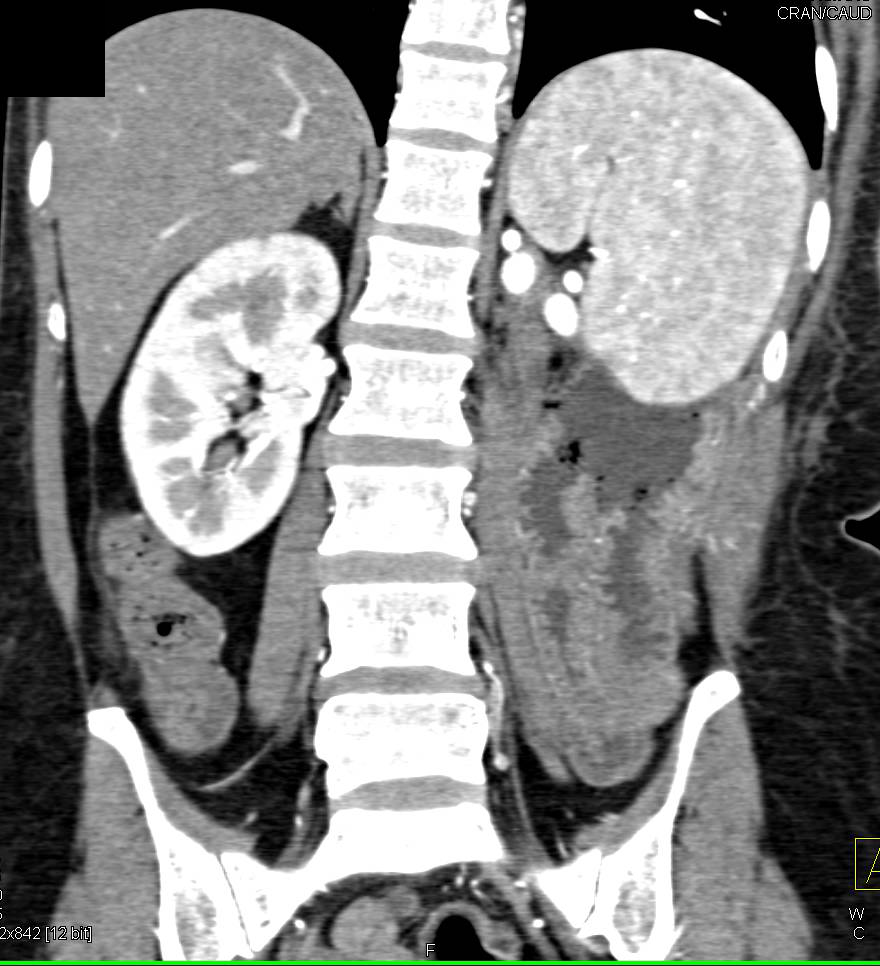 Left Sided Internal Hernia - CTisus CT Scan