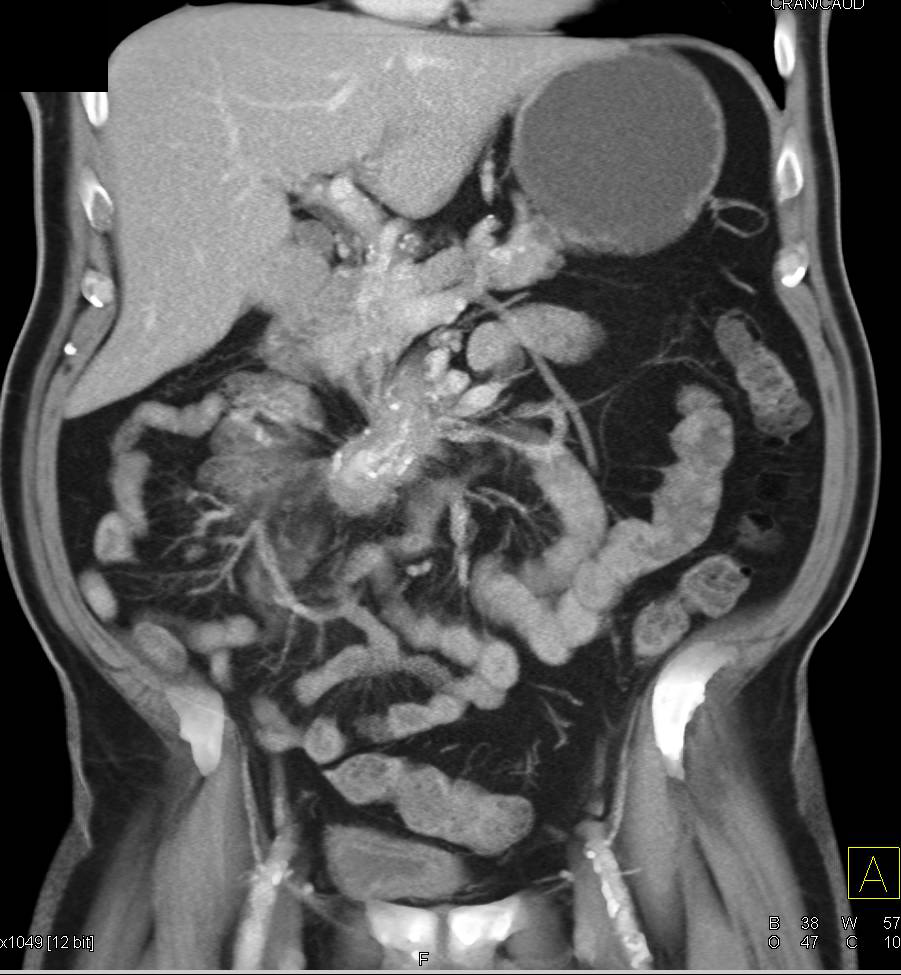 Carcinoid Tumor in the Root of the Mesentery - CTisus CT Scan