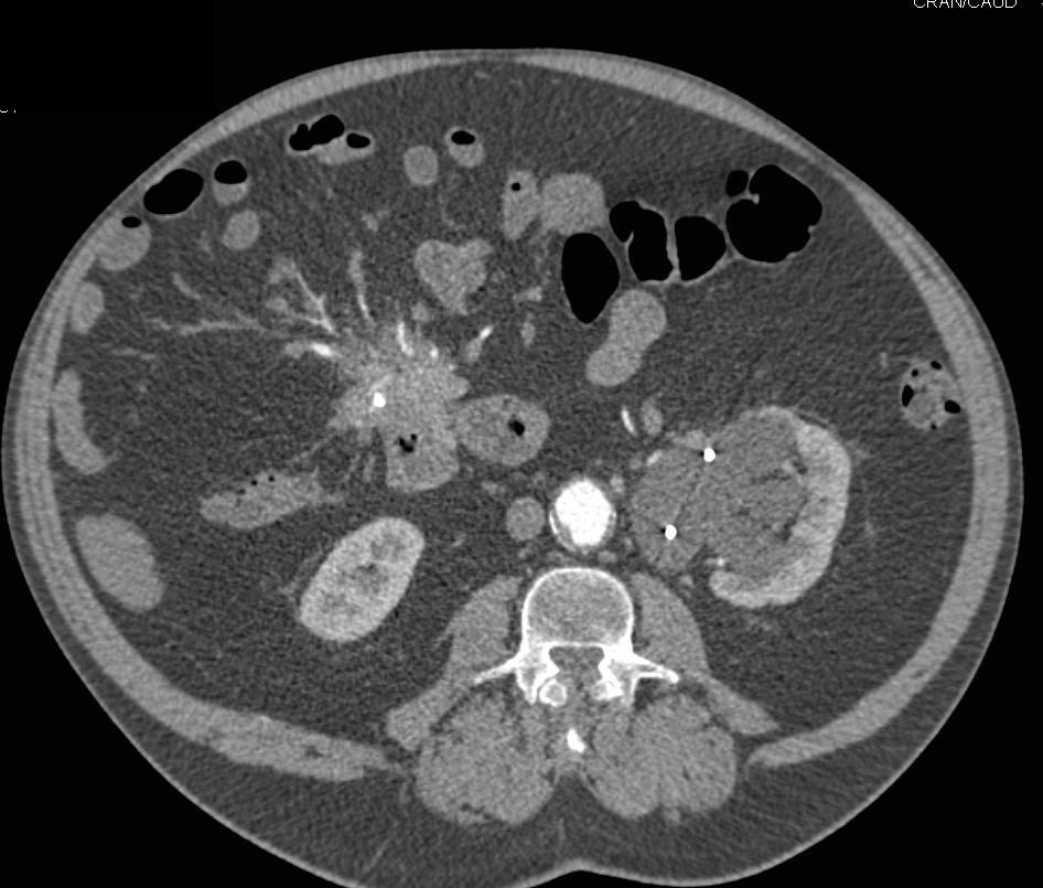Carcinoid Tumor with Desmoplastic Reaction Simulates a Pancreatic Cancer - CTisus CT Scan
