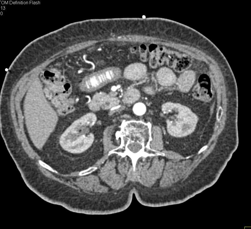 Ischemic Bowel with Peritonitis - CTisus CT Scan