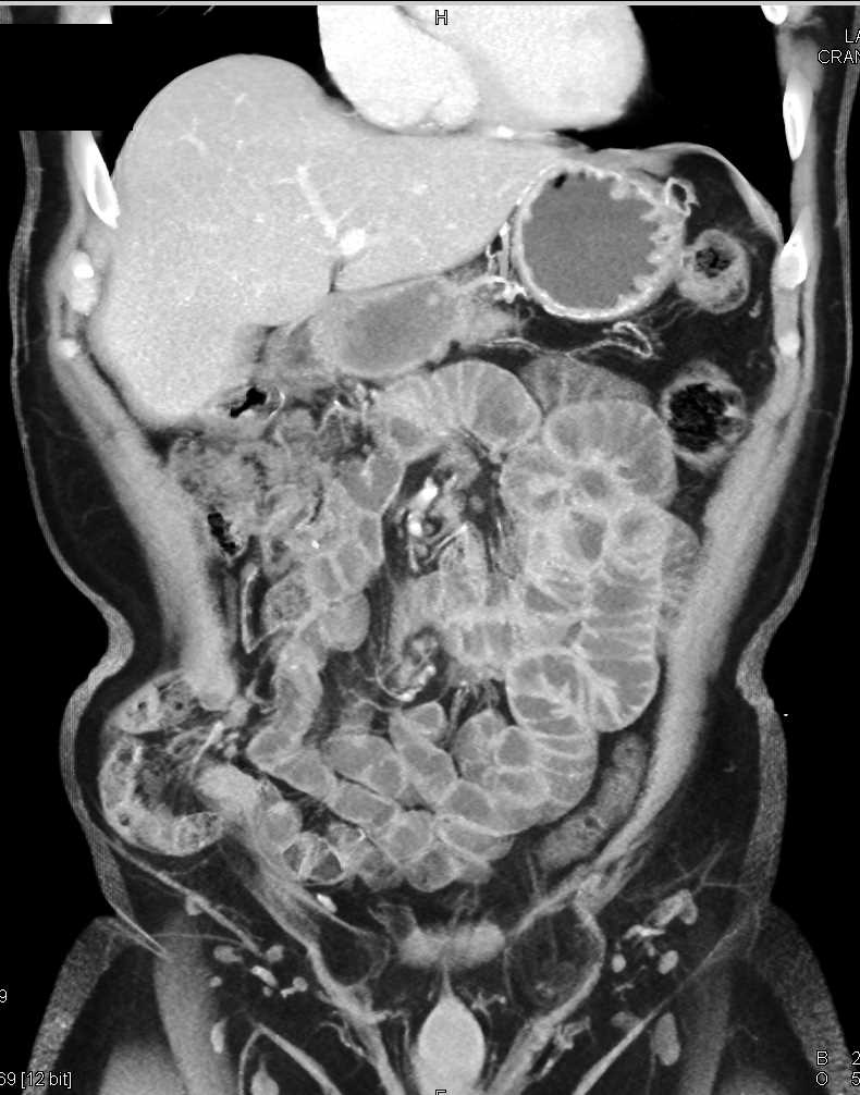 Hernia in Right Lower Quadrant with Small Bowel Obstruction - CTisus CT Scan