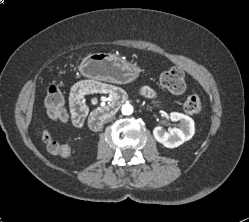 Malrotation of the Small Bowel - CTisus CT Scan