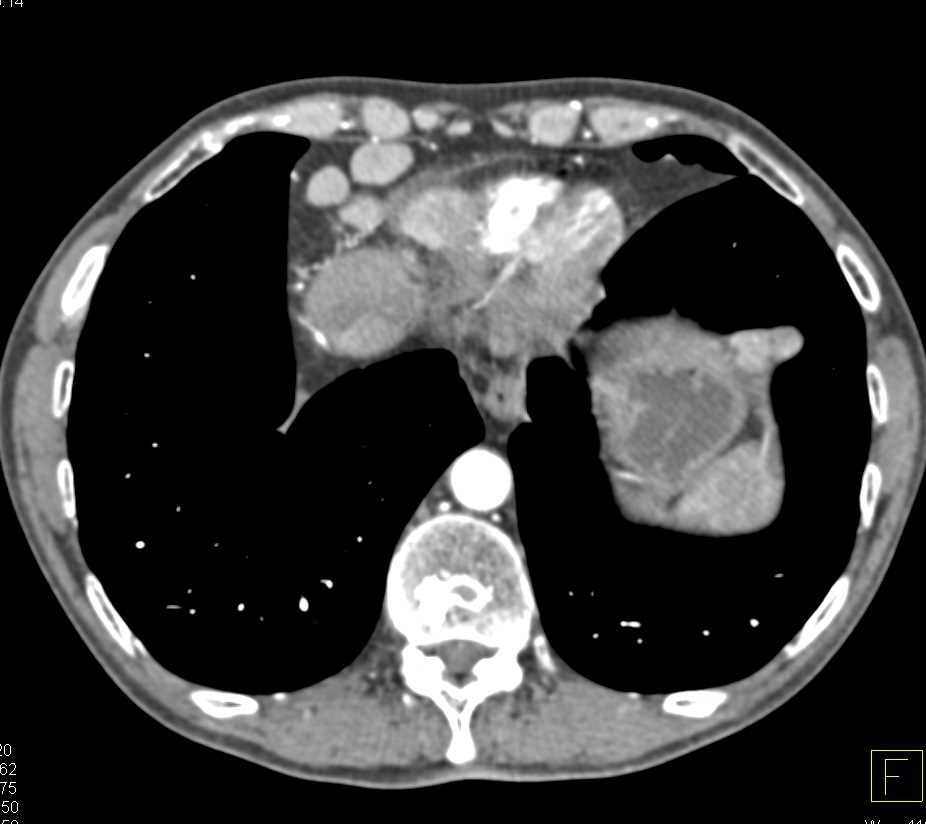 Implants of the Liver and Paracardiac Nodes in a Patient with Carcinoid Tumor - CTisus CT Scan