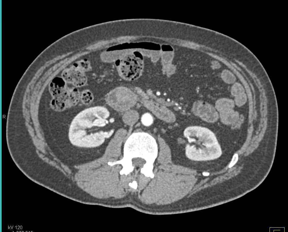 Duodenal Carcinoma in Second Portion of the Duodenum - CTisus CT Scan