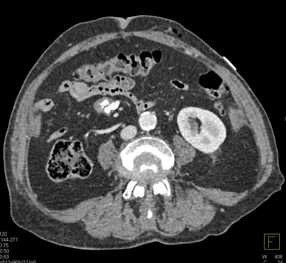 Carcinoid Tumor with Pulmonary Embolism - CTisus CT Scan