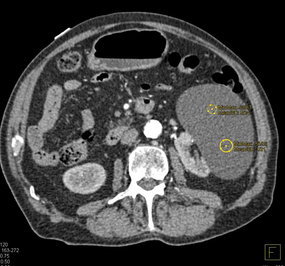 Carcinoid Tumor with Calcified Mesenteric Mass - CTisus CT Scan