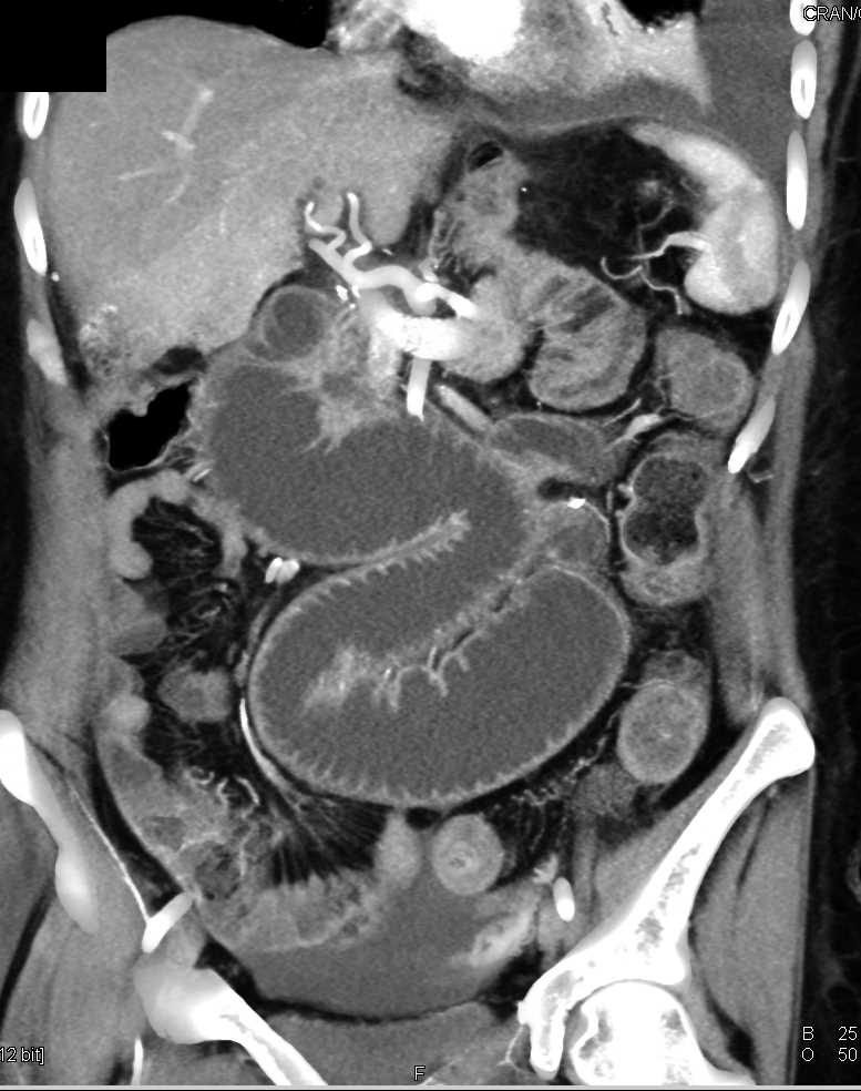 Small Bowel Obstruction with Carcinomatosis - CTisus CT Scan