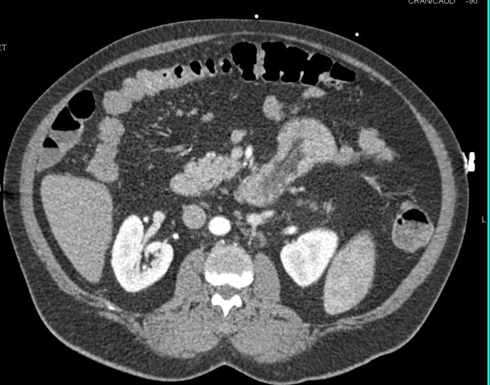 Duodenal Lipoma with Intussusception - CTisus CT Scan