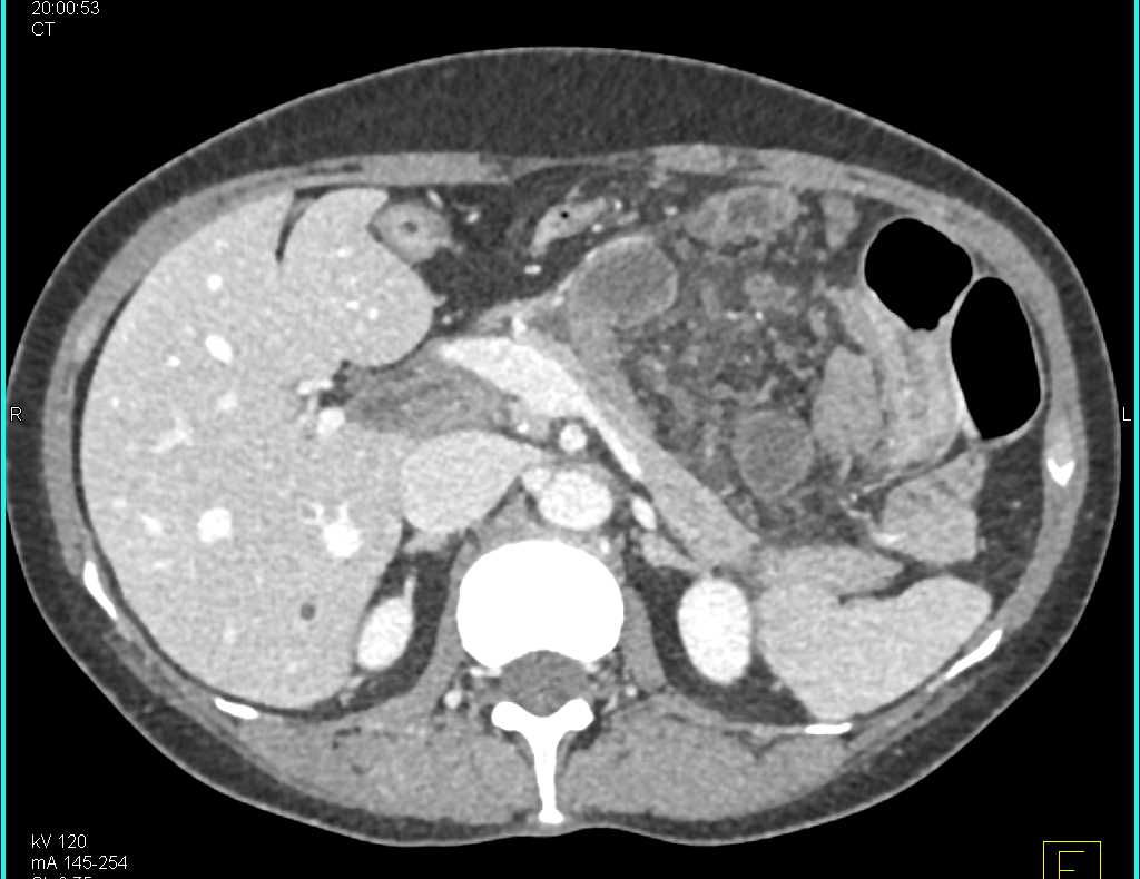 Internal Hernia with Midgut Volvulus with Small Bowel Obstruction and Ischemic Bowel - CTisus CT Scan