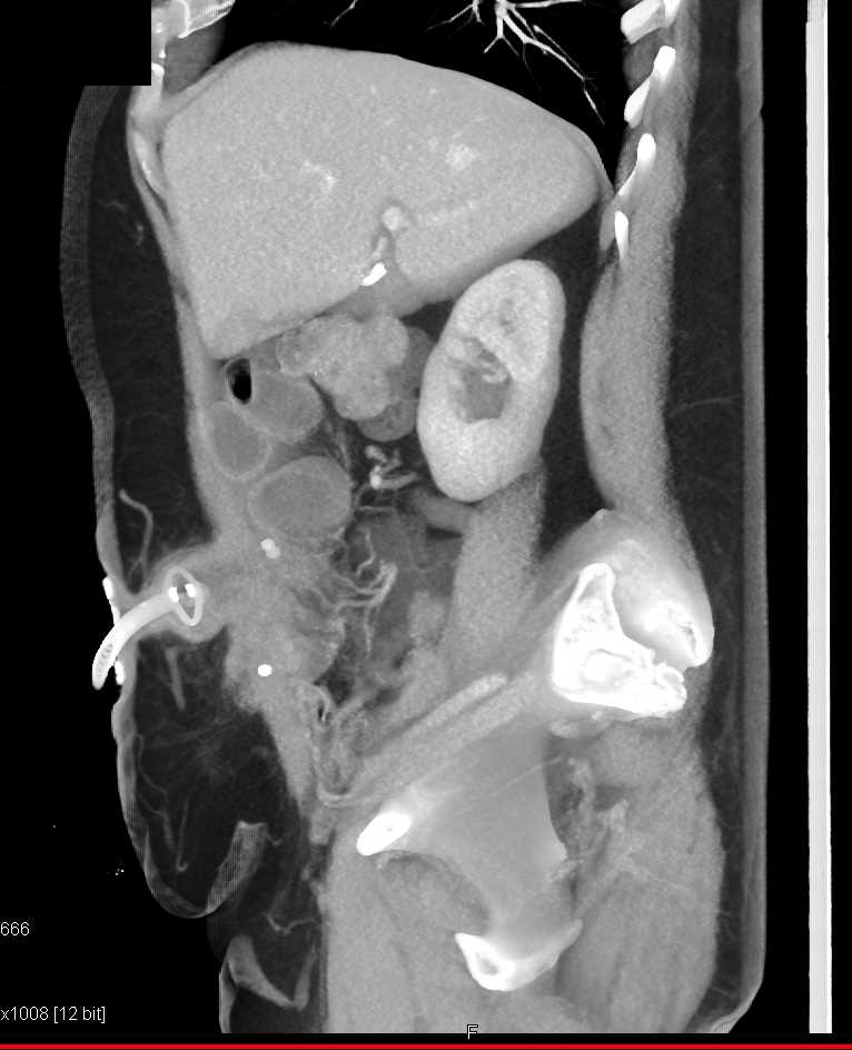 Crohn's with Diseased Small Bowel Through Osteomy - CTisus CT Scan