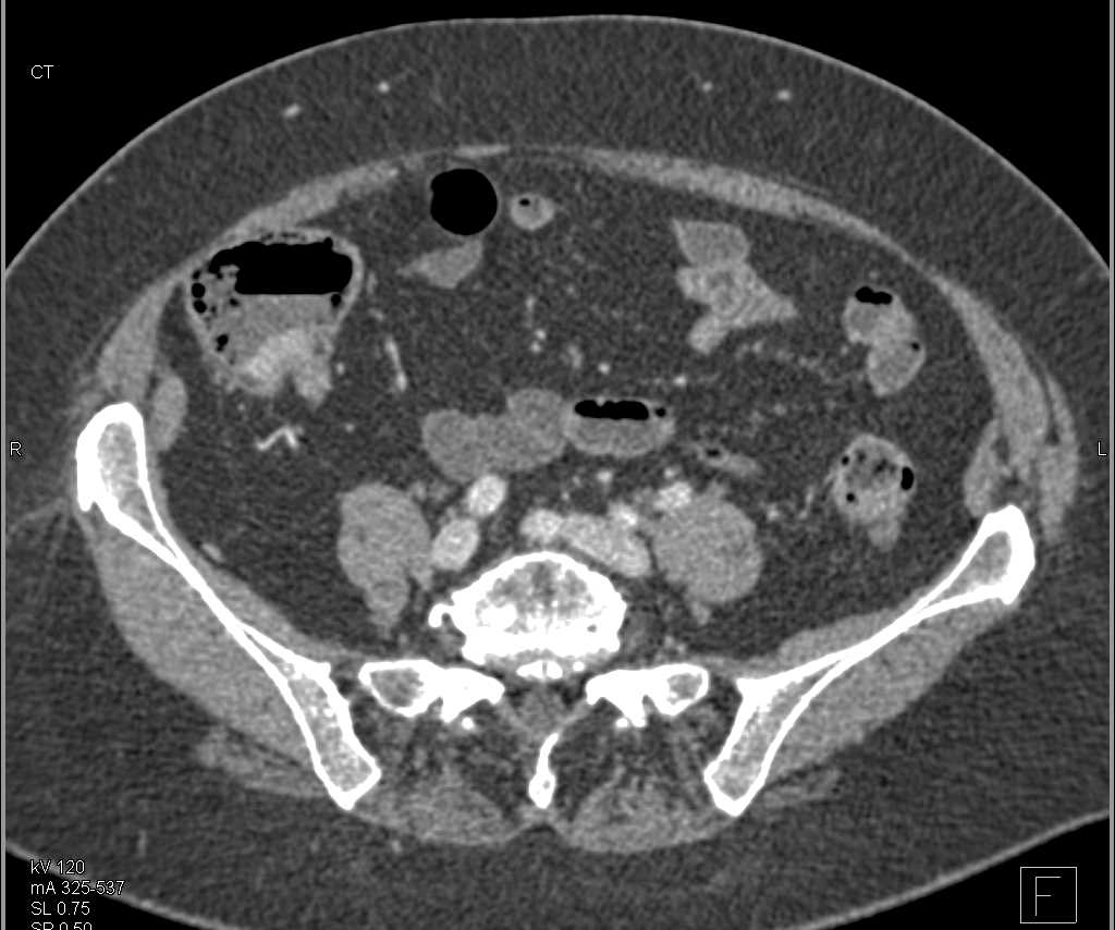 Carcinoid Tumor Near Ileocecal Valve with Liver Metastases - CTisus CT Scan