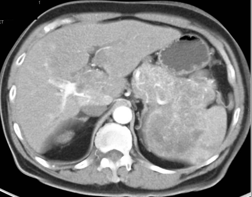 Neuroendocrine Tumor of the Pancreas Invades the Spleen and Extends from Splenic Vein Into Portal Vein - CTisus CT Scan