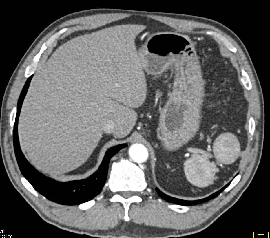Multiple Accessory Spleens in Patient s/p Splenectomy - CTisus CT Scan