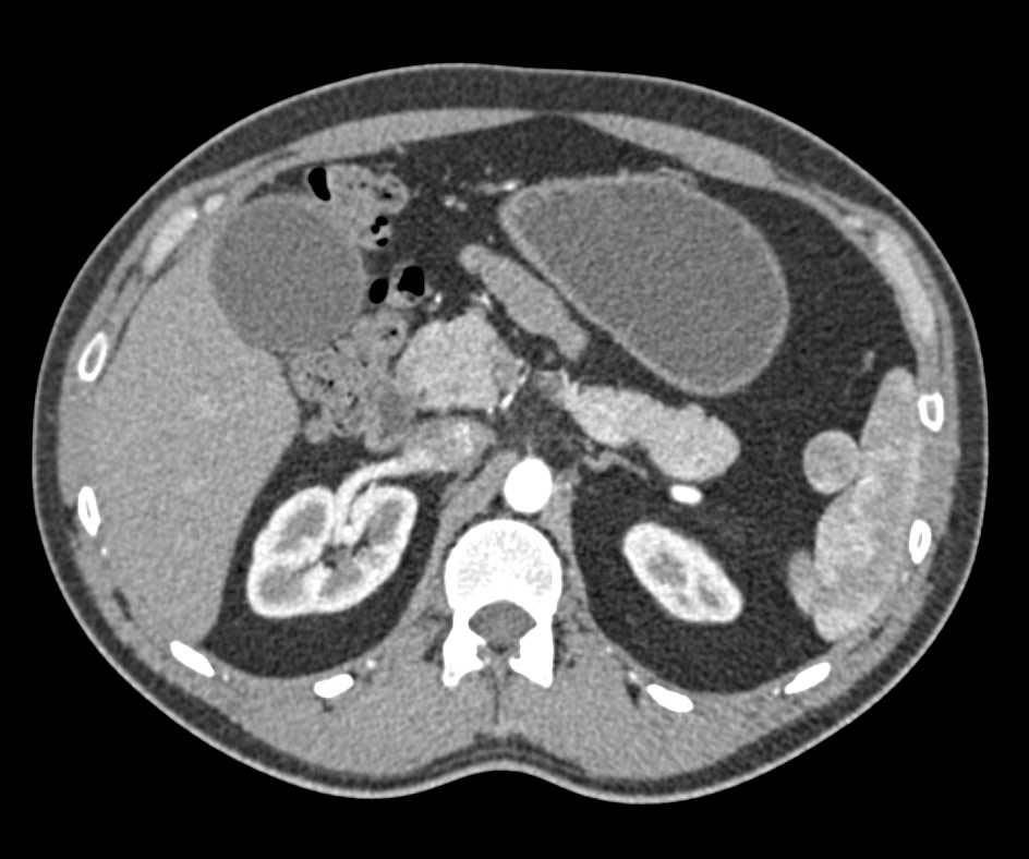 Accessory Spleen by the Hilum of the Spleen - CTisus CT Scan