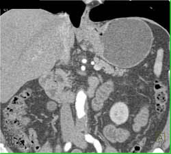 Carcinoma of the Gastric Fundus - CTisus CT Scan