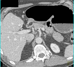 Antral Ulcer With Gastric Outlet Obstruction - CTisus CT Scan