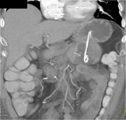 Drainage of A Pseudocyst Into the Stomach - CTisus CT Scan