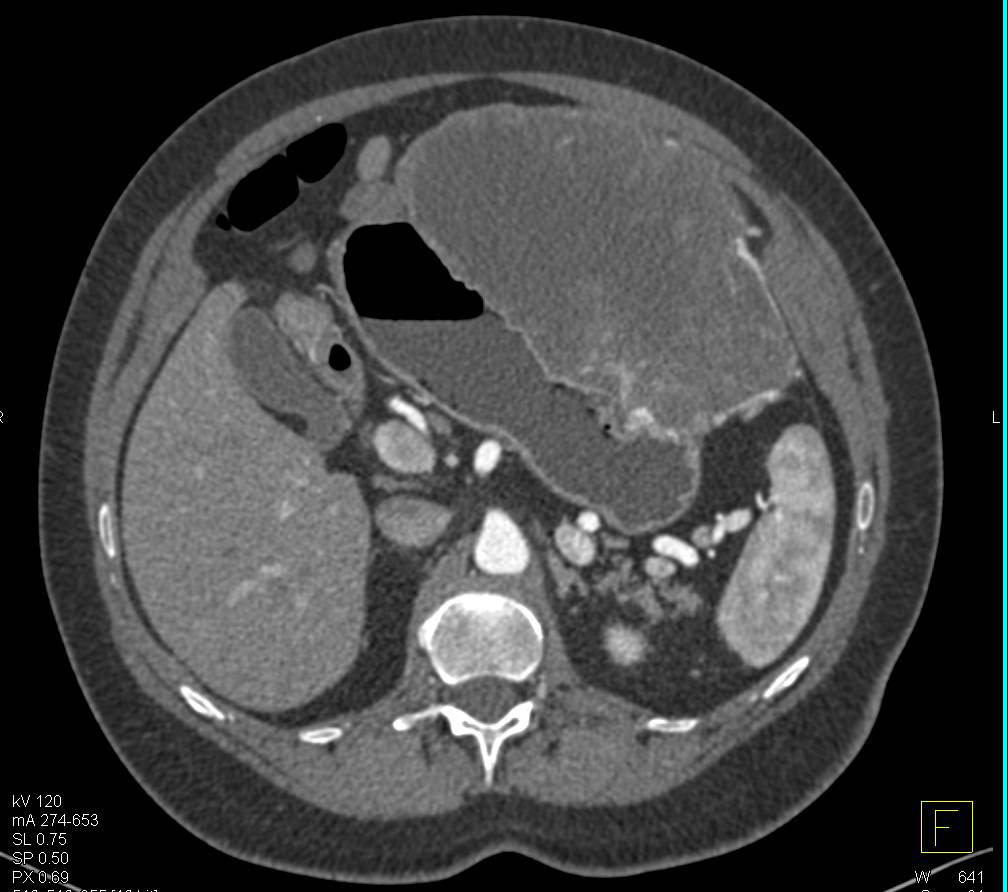 Large Gastric GIST Tumor - CTisus CT Scan
