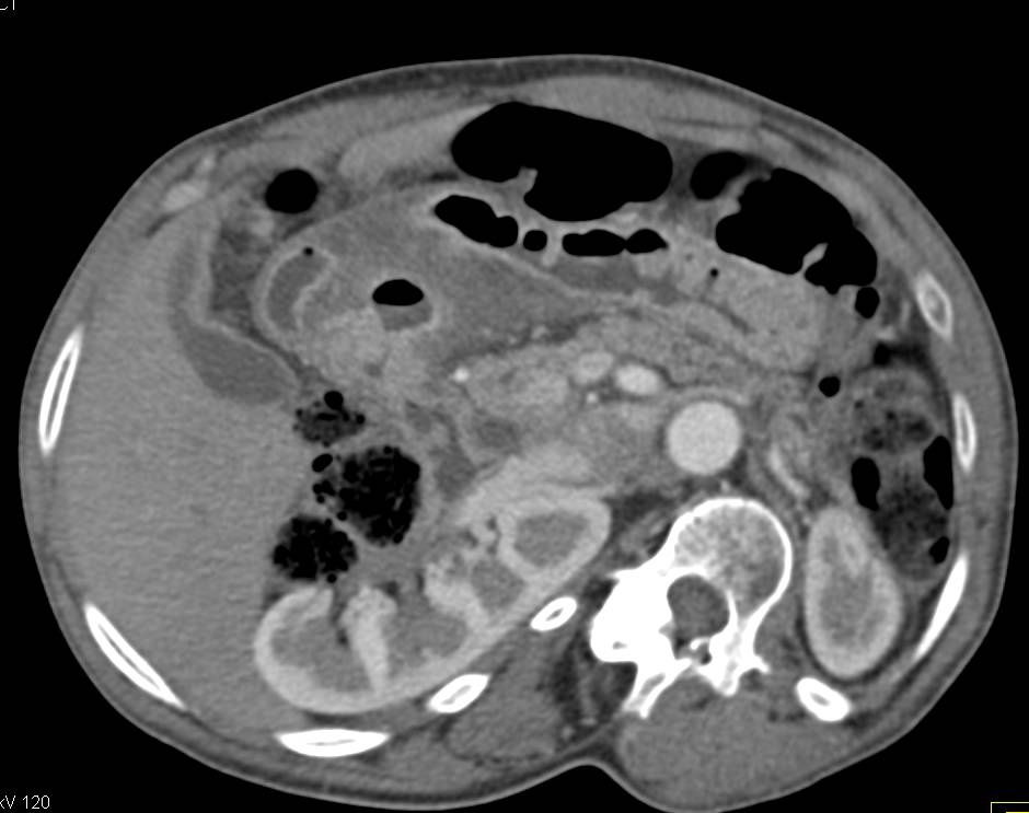 Perforated Antral Ulcer - CTisus CT Scan