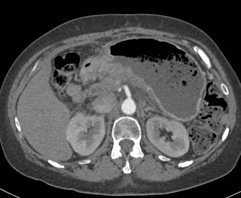 Recurrent Pancreatic Cancer Invades the Stomach - CTisus CT Scan