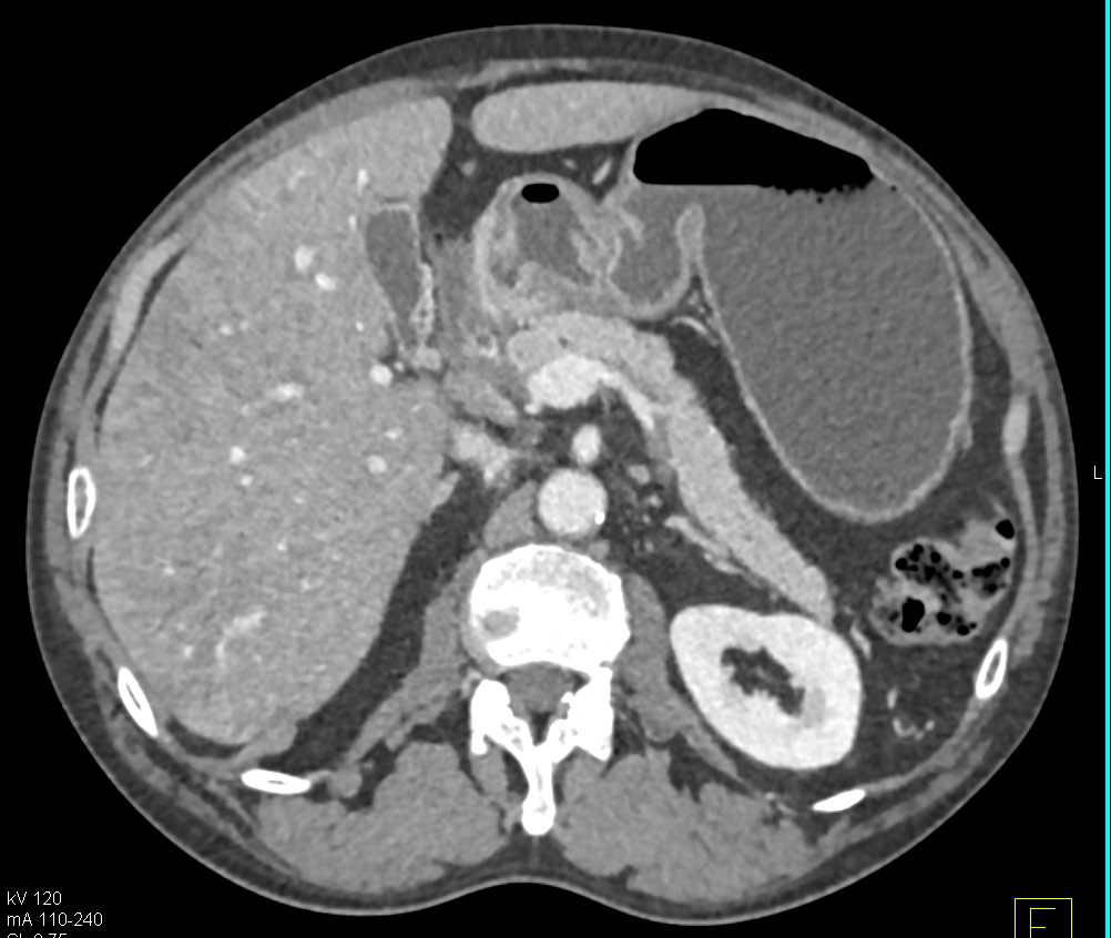 Carcinoid Tumor in the Duodenum with Thickened Antrum - CTisus CT Scan