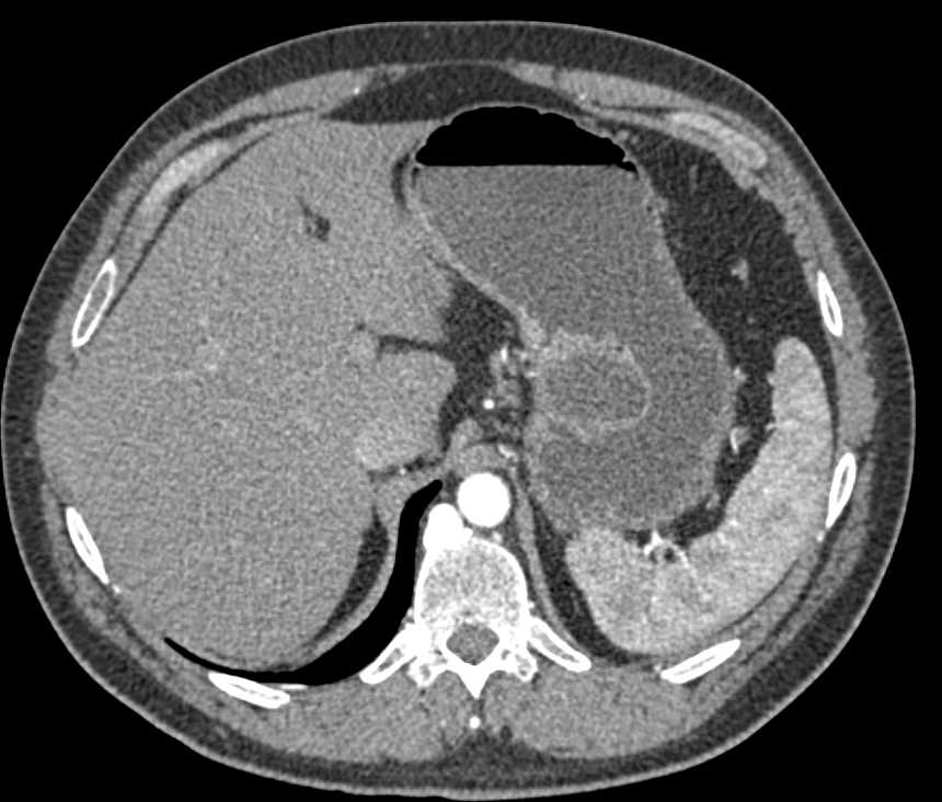Incidental Gastric GIST Tumor - CTisus CT Scan