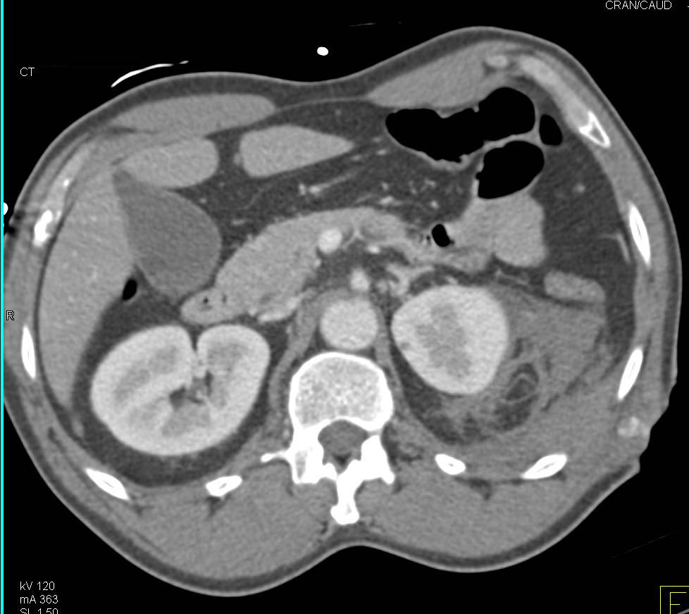 Renal Laceration Without Colon Injury - CTisus CT Scan