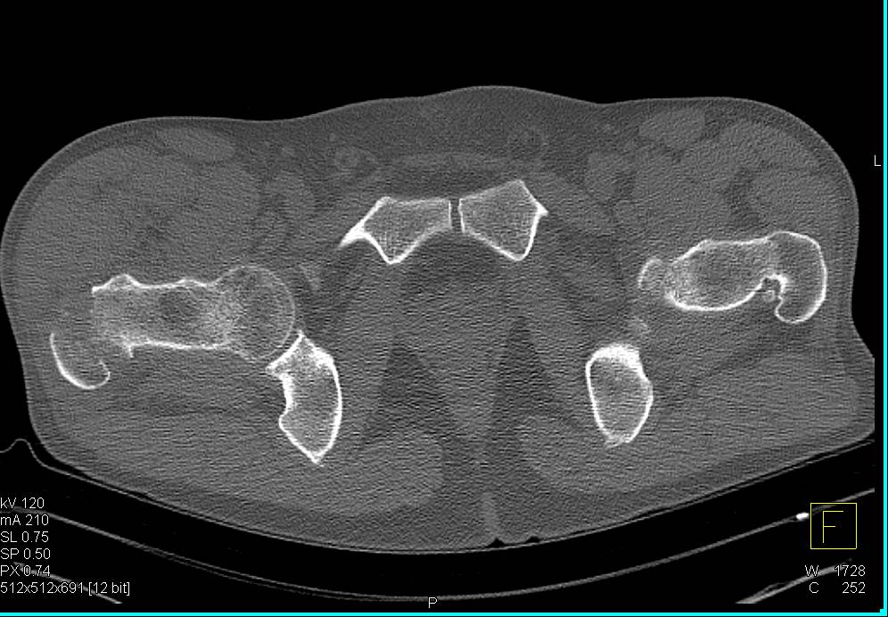 Inter-Trochanteric Fracture Right Femur - CTisus CT Scan