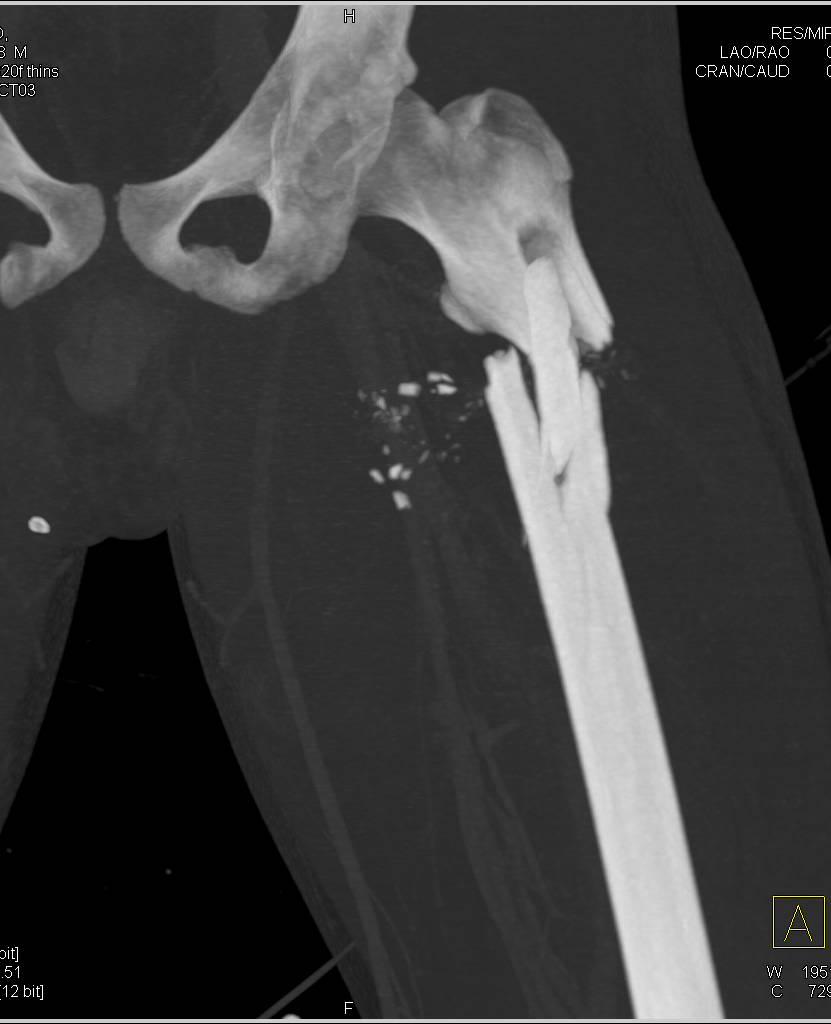 Femur Fracture with Bleed S/P GSW to Thigh - CTisus CT Scan