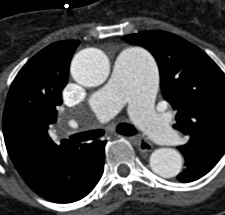 Chronic Pulmonary Embolism in Right Main Pulmonary Artery with Enlarged Bronchial Collateral Arteries - CTisus CT Scan