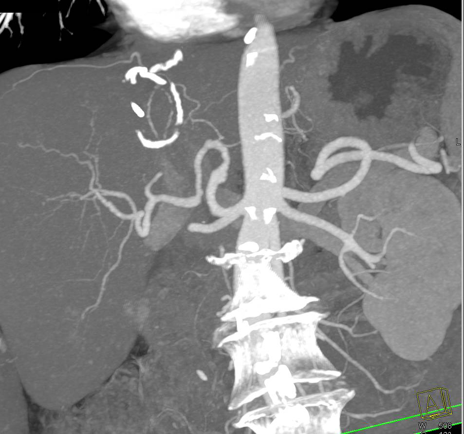 Small Hepatic Artery Aneurysm - CTisus CT Scan