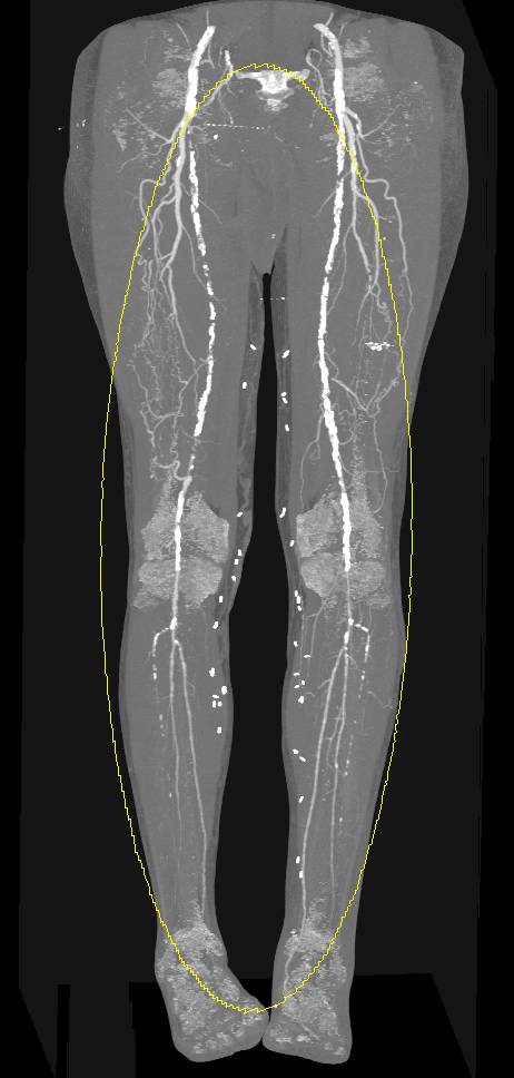 Runoff Using Dual Energy with Bone and Calcium Removal Shows Extensive Peripheral Vascular Disease (PVD) - CTisus CT Scan