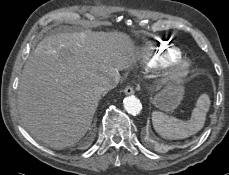 Inferior Vena Cava (IVC) Extension of a Hepatocellular Carcinoma (Hepatoma) - CTisus CT Scan