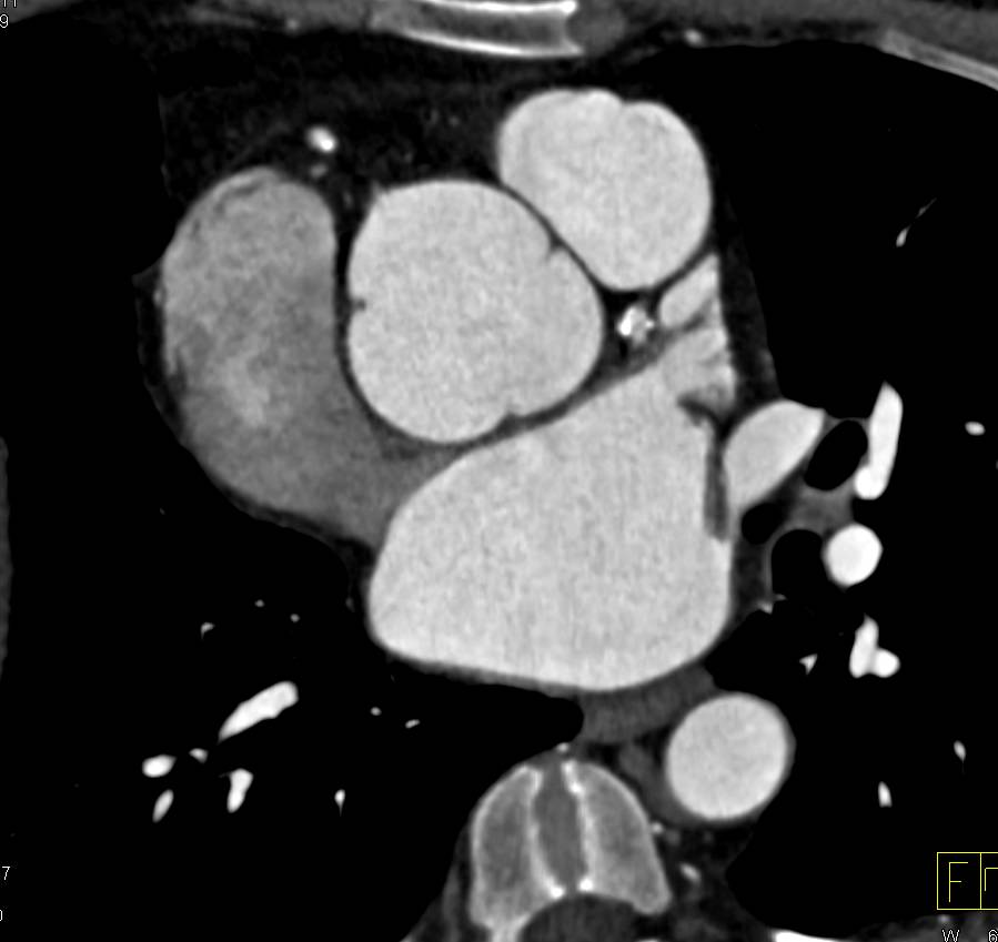 Dilated Aortic Root in Marfan Syndrome - CTisus CT Scan