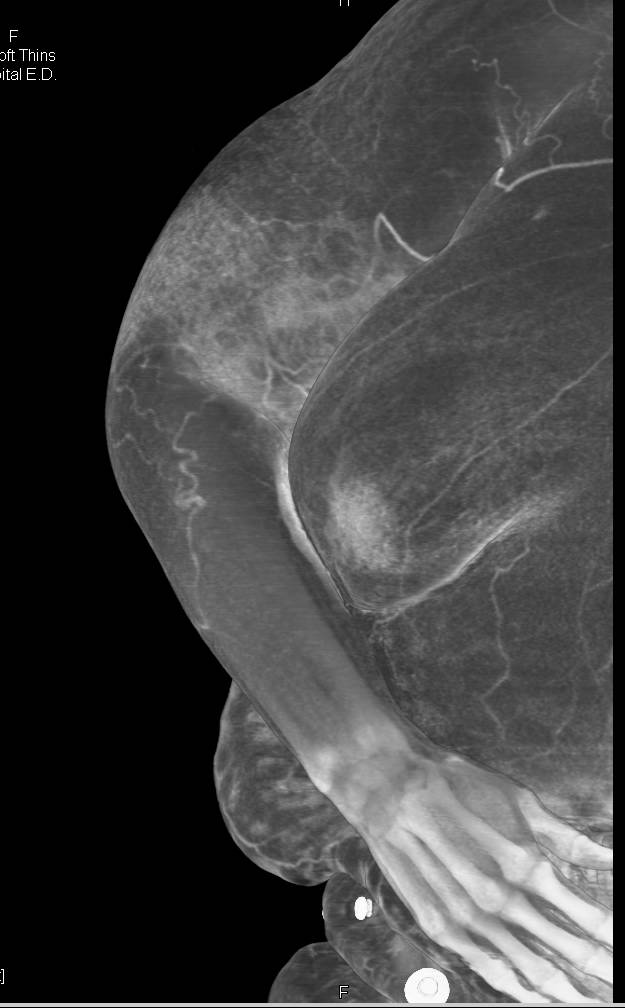Arteriovenous (AV) Fistulae Arm in Dialysis Patient - CTisus CT Scan
